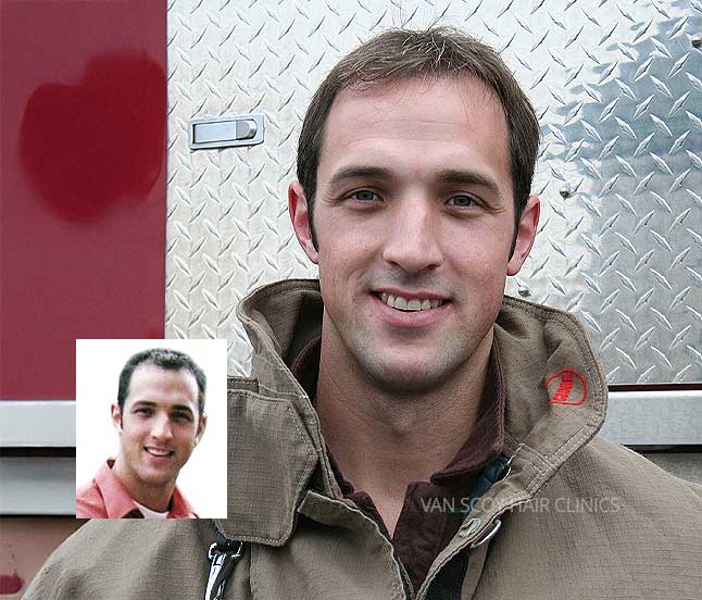 Advanced-Hair-Transplant-Restoration-Surgery-Van-Scoy-Clinics-Ohio Hair Transplant Solutions Ohio