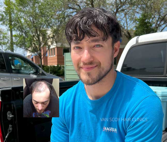 mens-non-surgical-custom-hair-replacement-systems-cleveland-ashland-columbus-ohio-van-scoy mens non-surgical custom hair replacement systems cleveland ashland columbus ohio van scoy