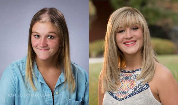 comprehensive women's hair loss solutions Van Scoy hair clinics cleveland columbus ashland ohio