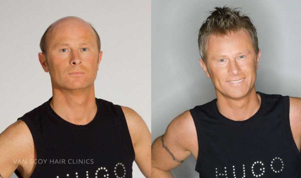 men's hair restoration ohio