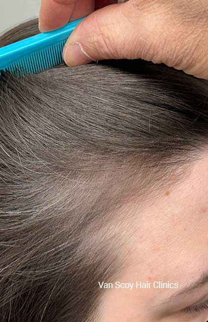 DeRive-hair-restoration-Van-Scoy-Hair-Clinics-Ohio DeRive hair restoration Van Scoy Hair Clinics Ohio