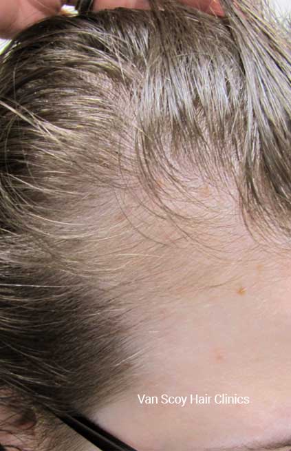 DeRive-hair-restoration-treatment-Cleveland-Ohio DeRive hair loss treatment Van Scoy Hair Clinics Cleveland Ohio
