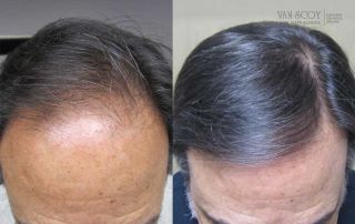 FUE Hair Transplant Ohio