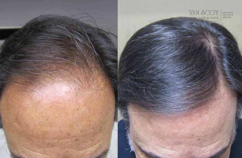 FUE Hair Transplant Ohio