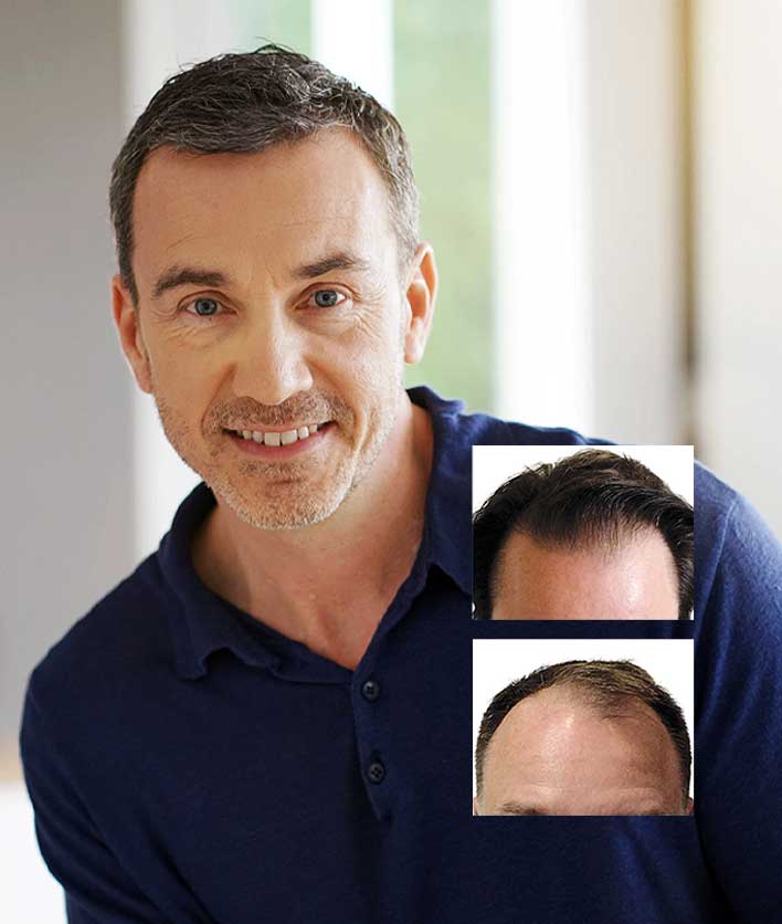 FUE-Hair-Transplant-Surgeon-Cleveland-Columbus-Ohio FUE hair transplant Ohio