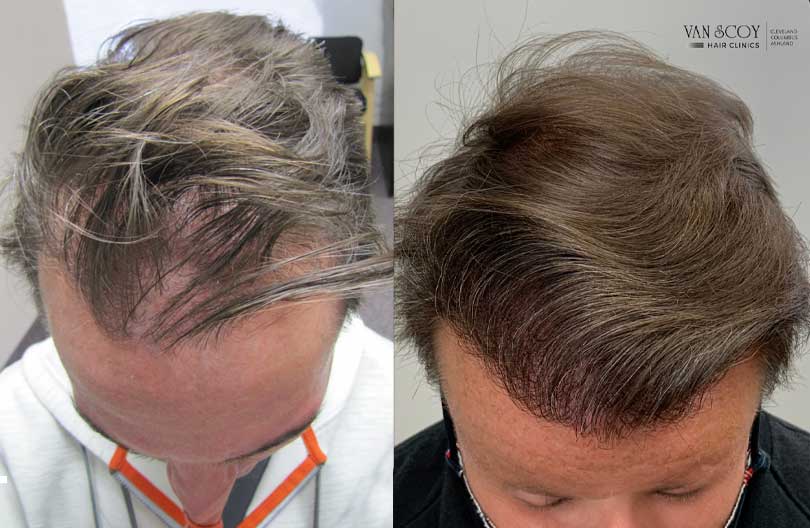 FUE Hair Transplant Van Scoy Hair Clinics Cleveland OH