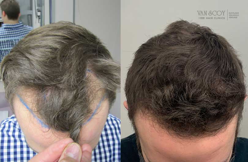 FUE Hair Transplant Van Scoy Hair Clinics Cleveland OH