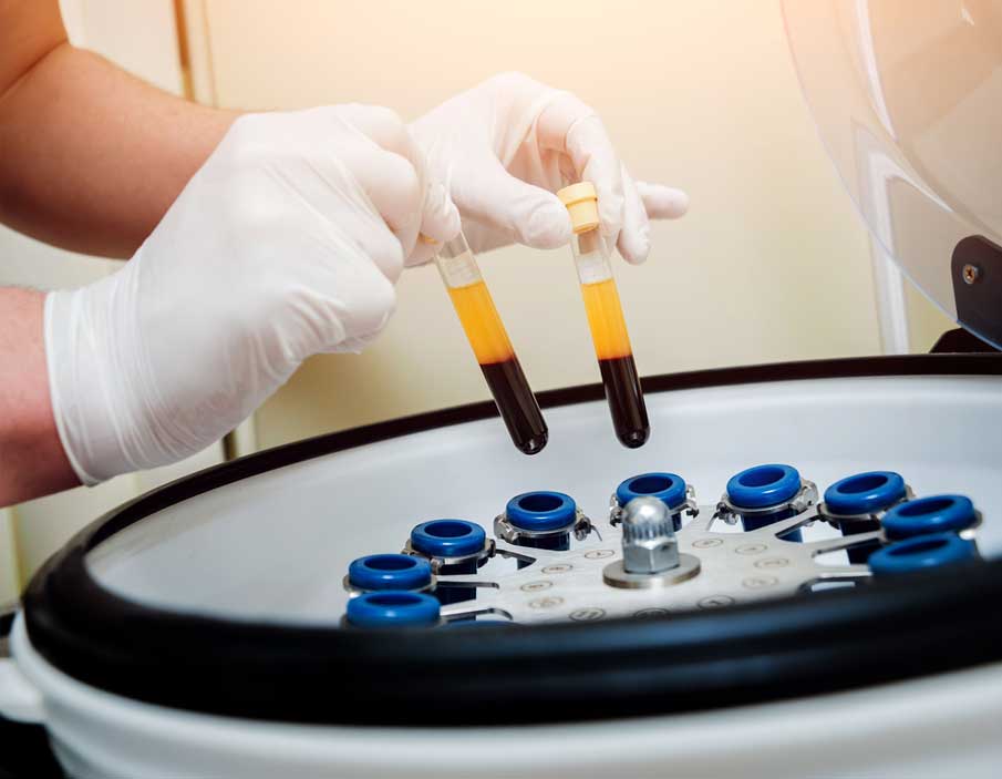 PRP-Hair-Regrowth-Therapy-Cleveland-Columbus-Ashland-Ohio PRP Hair Regrowth Therapy Cleveland Columbus Ashland Ohio