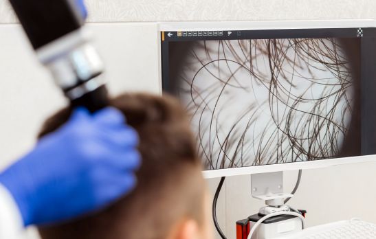 Trichoscopy of hair and scalp closeup. Precise and professional approach to hair and scalp health diagnosis.