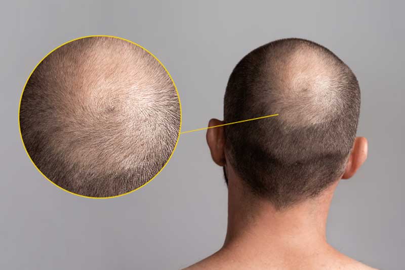 Types of Hair Loss: Definitions, Causes & How to Identify Yours