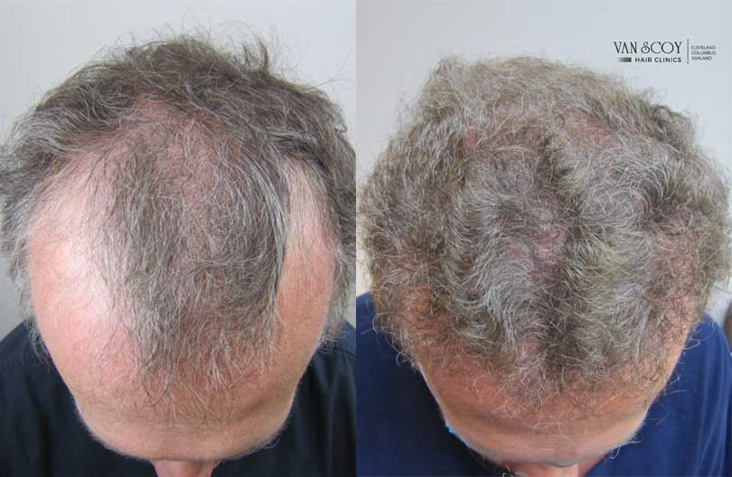 Van Scoy Hair Transplant Clinics Ohio