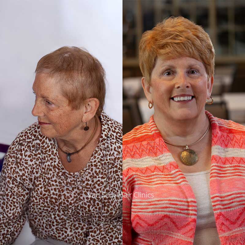 Carol custom women's non-surgical hair replacement results at Van Scoy hair Ohio