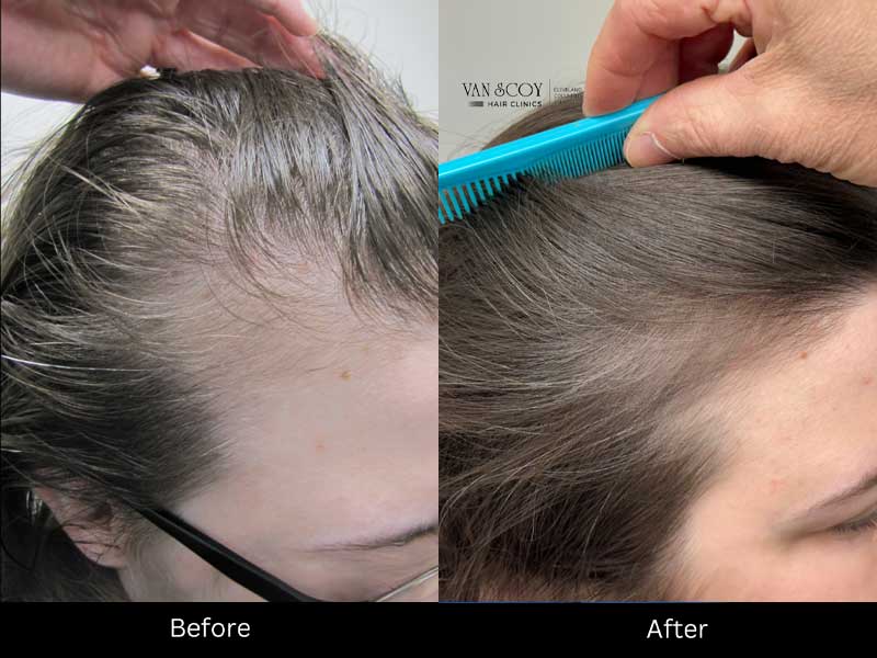 Exosome hair regrowth clinic Cleveland Columbus Ashland Ohio