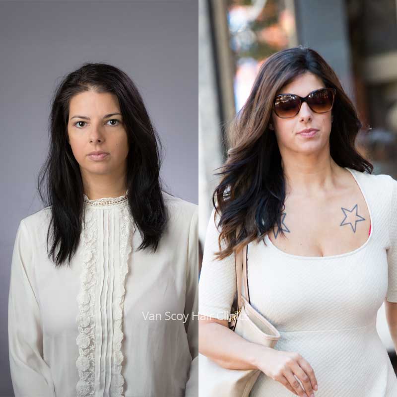 female hair loss replacement results van scoy ohio