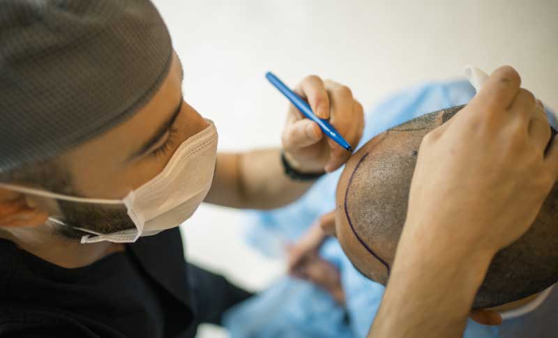 hair-transplant-faq-van-scoy-hair-clinics-cleveland-columbus-ohio hair transplant faq van scoy hair clinics cleveland columbus ohio