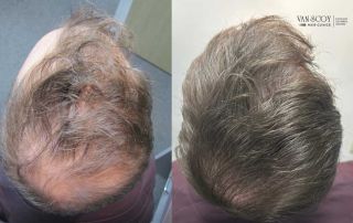 hair transplant fue cleveland ohio
