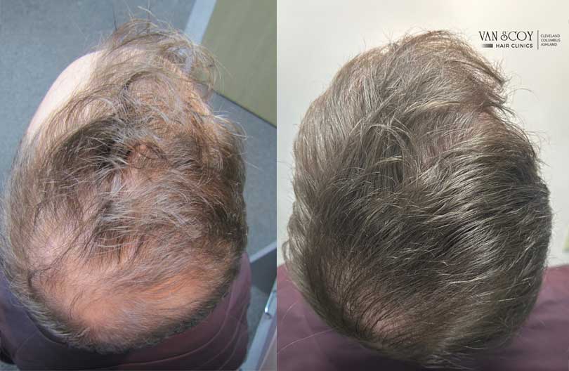 hair transplant fue cleveland ohio