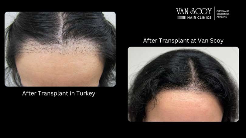 FUE Hair Transplant Van Scoy Hair Clinics Cleveland OH