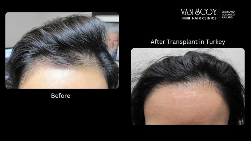 FUE Hair Transplant Van Scoy Hair Clinics Cleveland OH