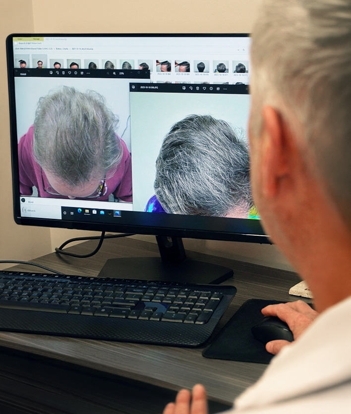 hair-transplant-revision-repair-van-scoy-hair-clinics-cleveland-columbus-ohio turkey hair transplant repair cleveland ohio van scoy clinics