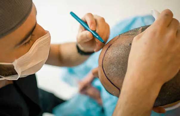 hair-transplant-timeline-vanscoy-hair-clinic hair transplant timeline vanscoy hair clinics ohio