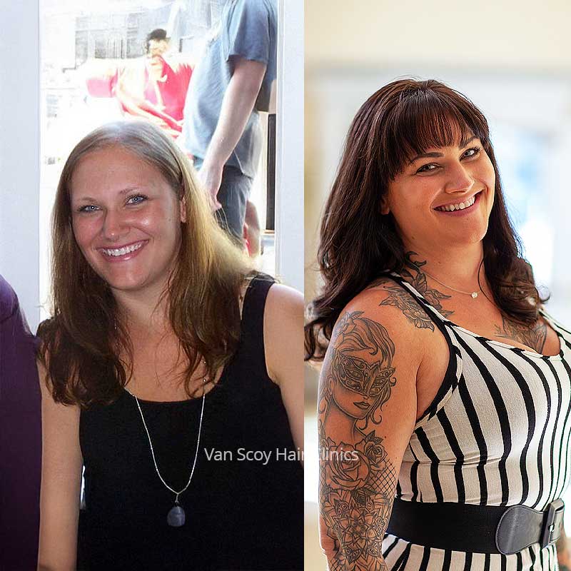 kace female pattern hair loss non-surgical hair replacement ohio