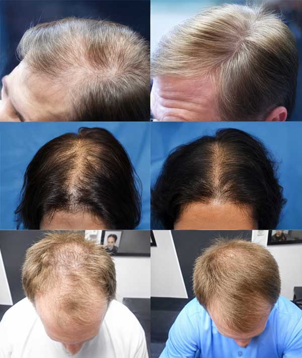 low level laser hair loss treatment therapy van scoy hair clinics ohio