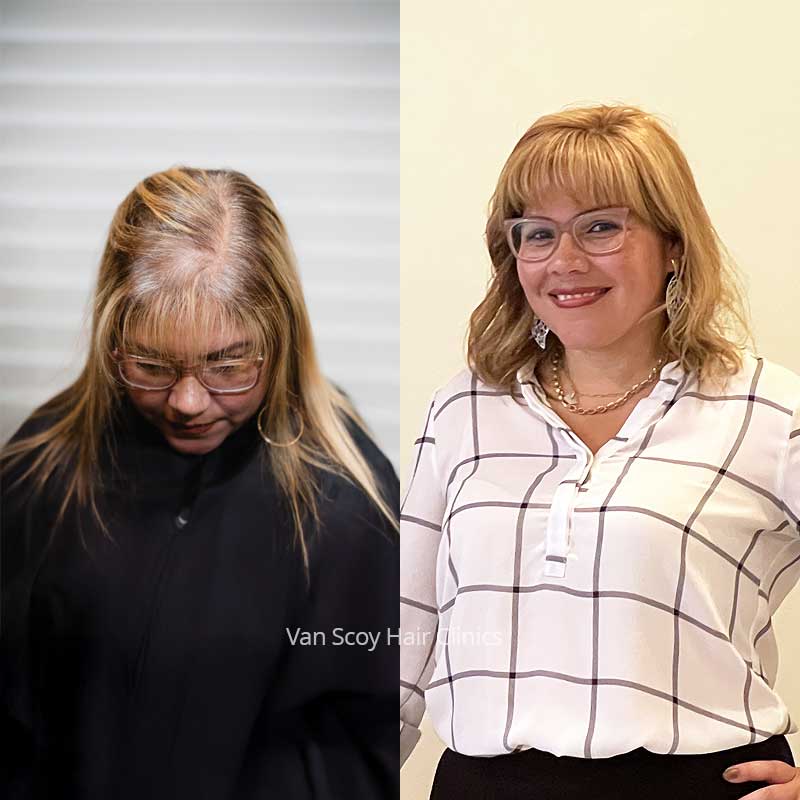 maria women's non-surgical hair replacement results Van Scoy Ohio