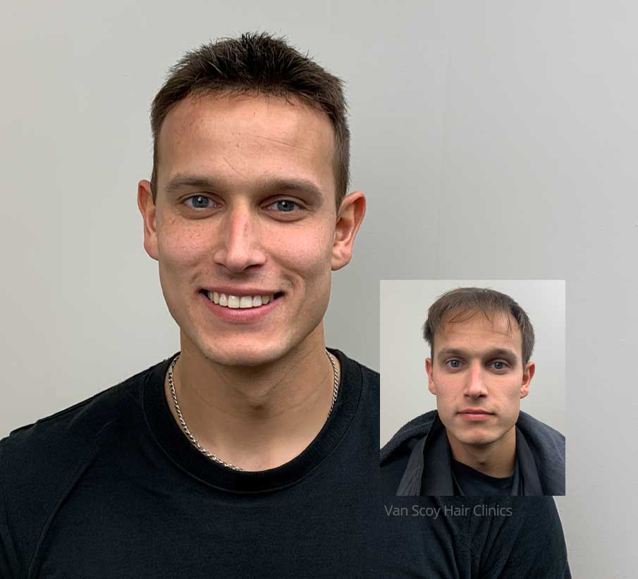 mens-hair-replacement-specialists-van-scoy-columbus-cleveland-ashland-ohio mens hair replacement specialists van scoy columbus cleveland ashland ohio