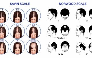 norwood savin scale