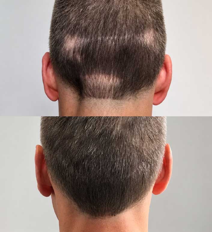 scalp-micropigmentation-hair-transplant-scar-repair-ohio Private complimentary consultation van scoy hair clinics cleveland ashland columbus ohio