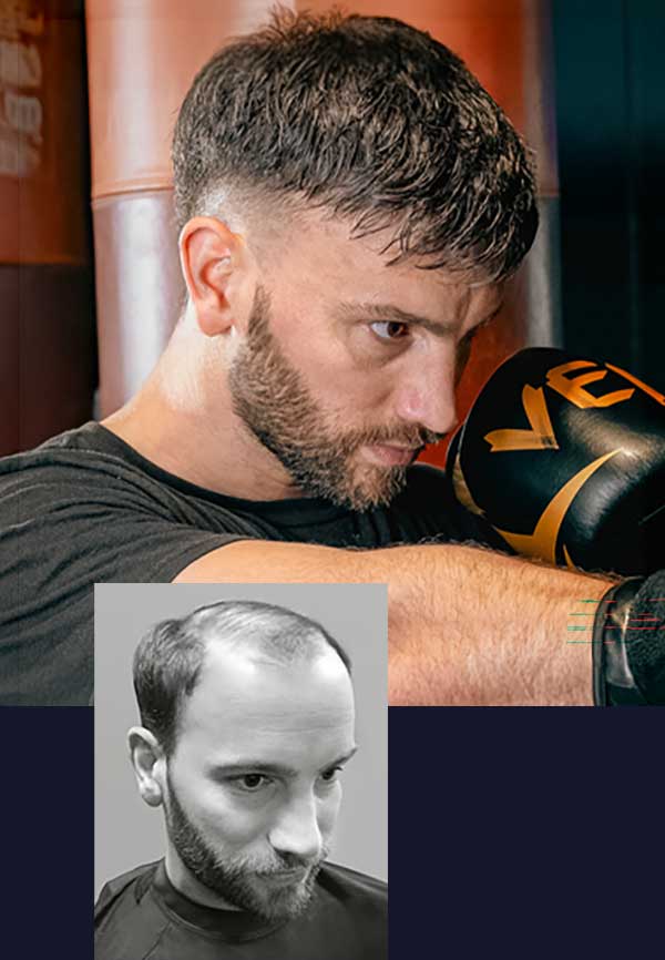 undetectable-custom-mens-hair-replacement-ohio undetectable custom mens hair replacement ohio
