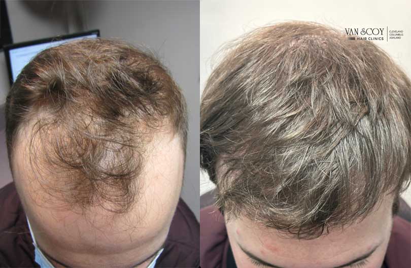 hair transplant fue cleveland ohio