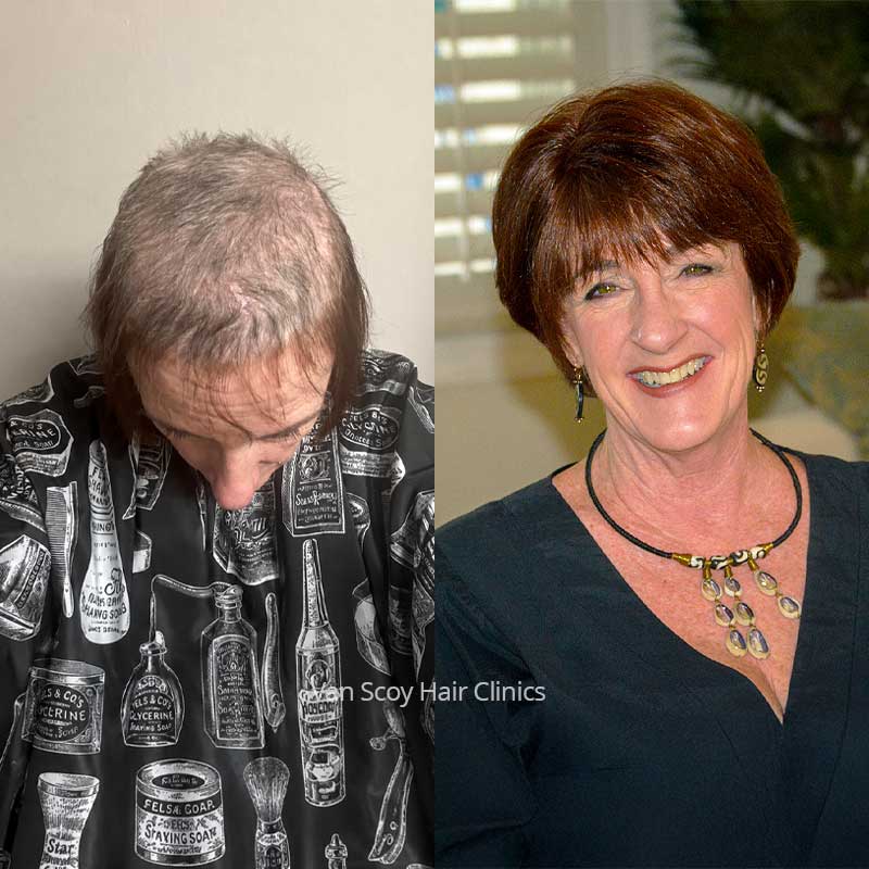 womens female pattern alopecia non-surgical hair replacement ohio