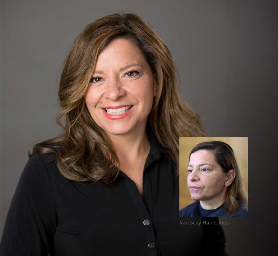 Women's Non-Surgical Hair Replacement Ohio van scoy hair clinics