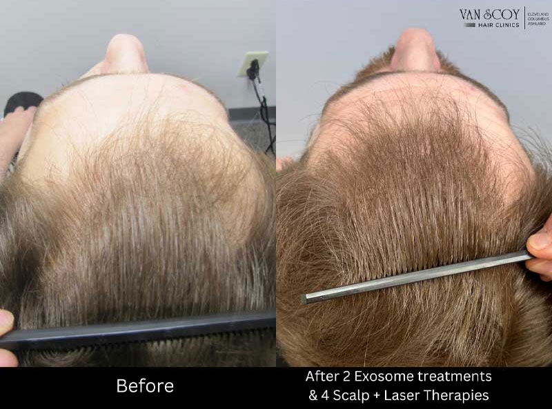 exosome hair restoration treatment van scoy cleveland columbus ashland ohio